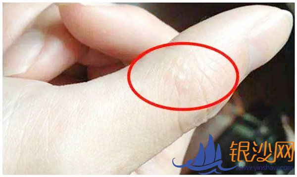 透明小水泡 健康警示灯